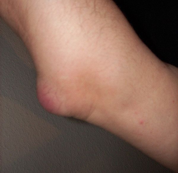 image relating to bursitis