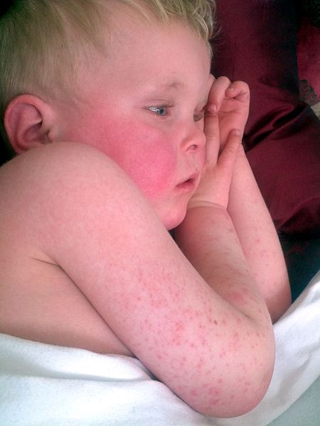 image relating to scarlet fever