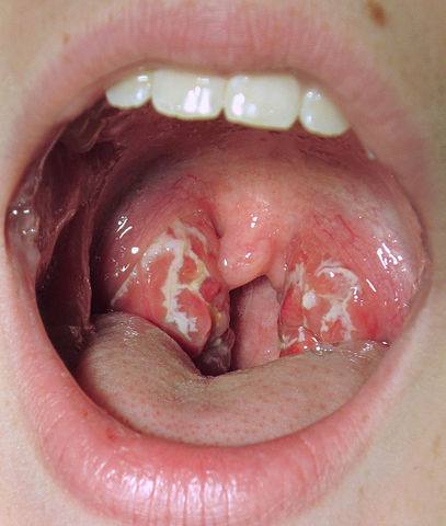 image relating to scarlet fever